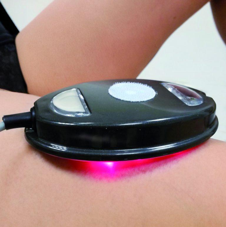 fotollltstimmatt - MYA LIPO STIM LASER