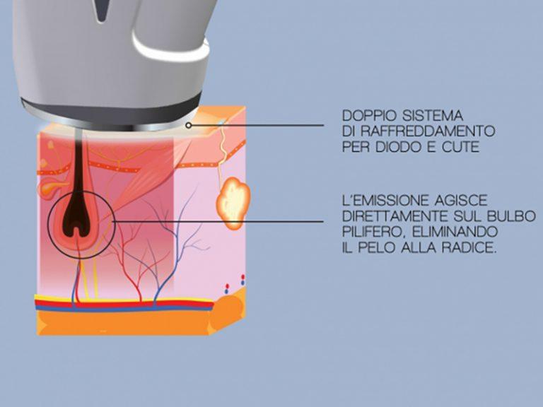 laser 1 - La nuova frontiera dell'epilazione: scopri l’ultima tecnologia!